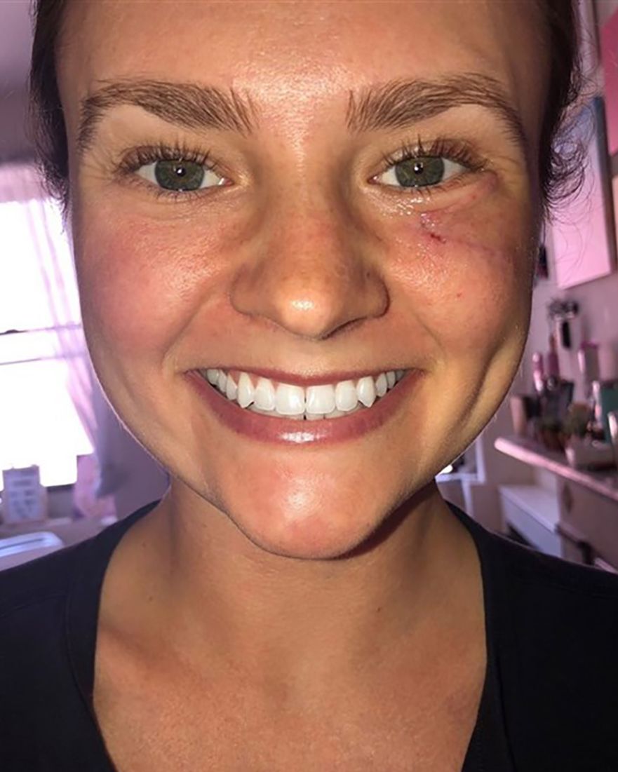 Esta mujer pensó que tenía un grano bajo el ojo, pero resultó ser cáncer de piel. 3