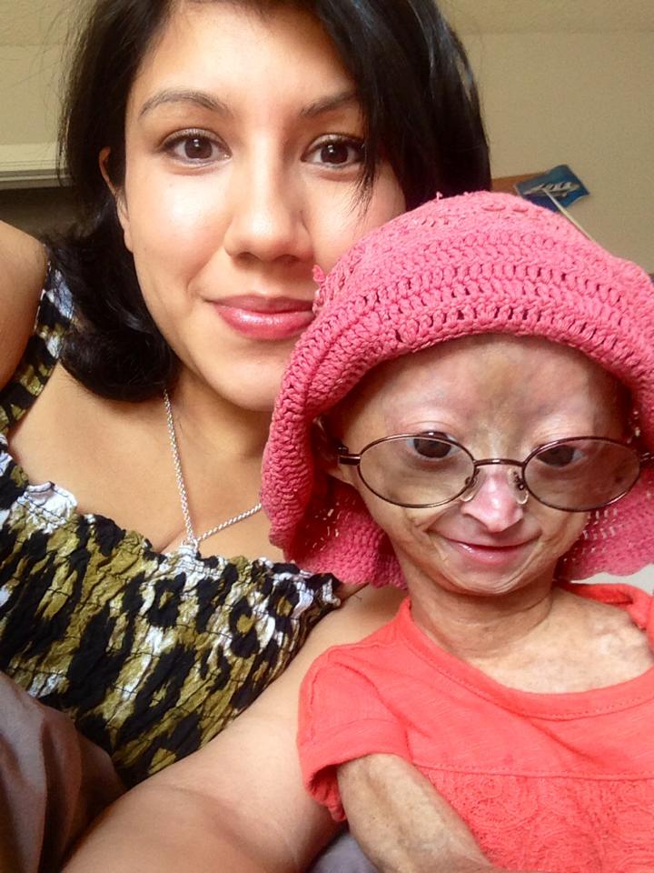 Adalia Rose, niña con envejecimiento prematuro