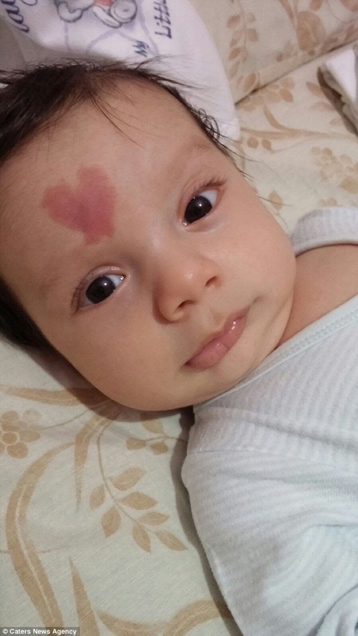 Niño con mancha en forma de corazón 