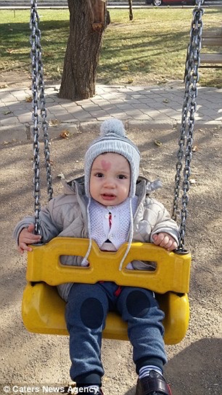 Niño con mancha en forma de corazón 