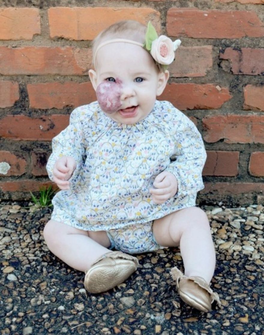 Niña con mancha de nacimiento en la cara