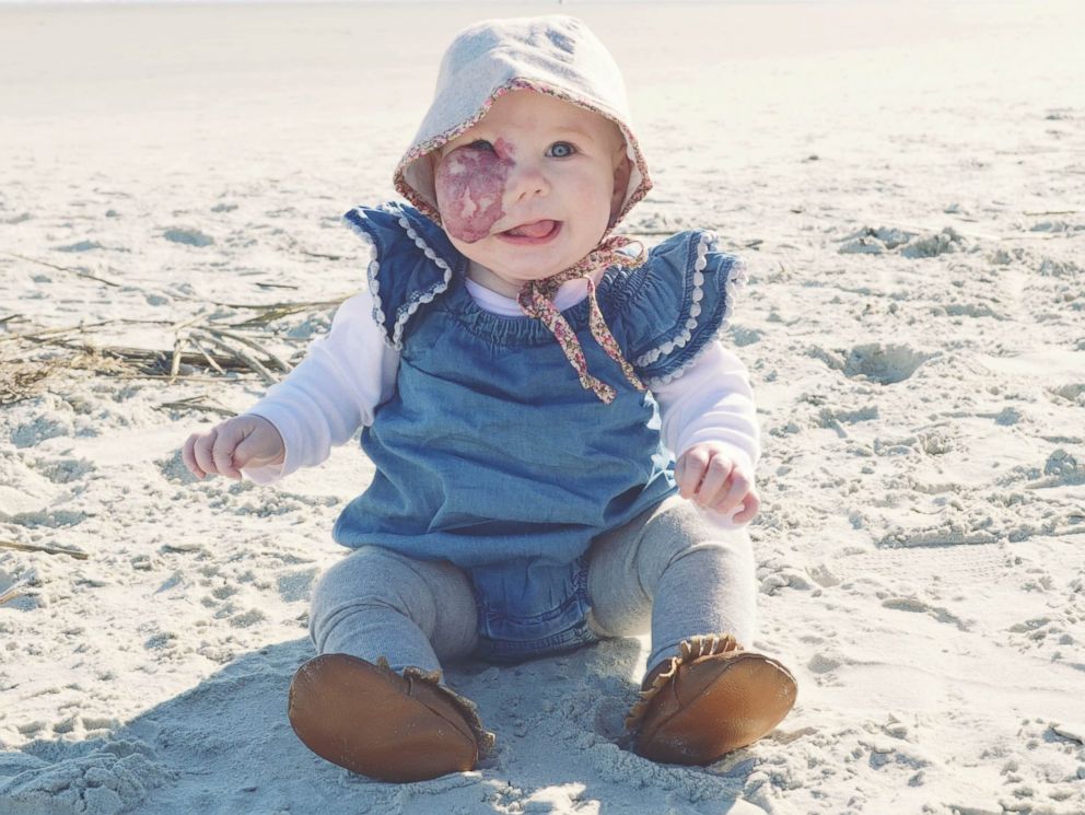 Niña con mancha de nacimiento en la cara