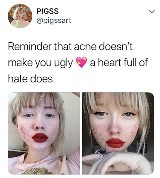 instagramer muestra su acne