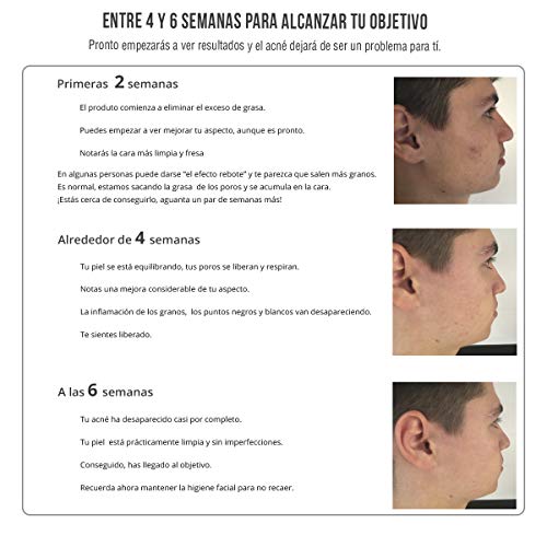 ACNÉ OUT. Tratamiento Antiacne de Choque. Elimina el acne facial, espinillas y granos. Lote 3 productos 1 Espuma purificante 1 Serum regulador piel grasa 1 Crema antiacne