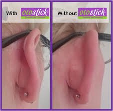 Otostick Corrector de Orejas 8 unidades *PACK DE 5* de Reva Health