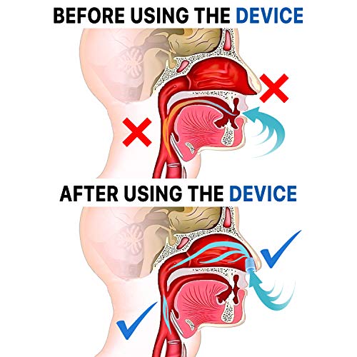 Dilatador Nasal Antironquidos para Dormir sin Roncar-Buscas como Dejar de Roncar- Anti Ronquidos Dispositivo Nariz Soluciones Apnea del Sueño Congestion Nasal-Breathe Right Silent Snore Deportivo