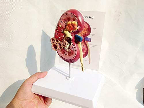 LBYLYH Riñón Humano con el Modelo Adrenal, el Modelo de Enfermedad renal con réplica de la anatomía de la Herramienta de Escritorio Medici Corporal del Paciente renal