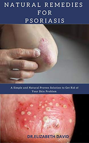 NATURAL REMEDIES FOR PSORIASIS: A Simple and Natural Proven Solution to Get Rid of Your Skin Problem : Dermatitis, Eczema, Psoriasis & Rosacea and Others (English Edition)