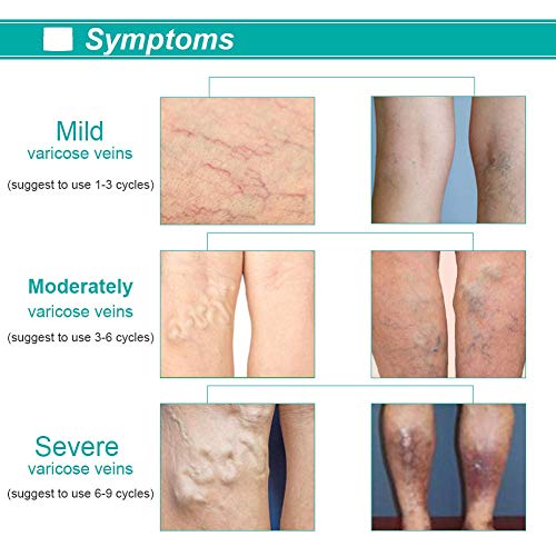 Parche de venas varicosas, tratamiento de venas varicosas, parche de curación de venas para arañas, edema, dolor nervioso, dolor de piernas, parches herbarios naturales