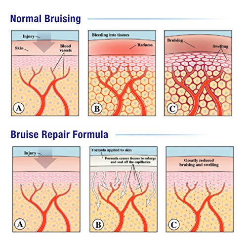 Gel Bruise MD™: crema para hematomas para el tratamiento y la prevención de los hematomas. Limpiador de hematomas médico de clase 1, para la cara y el cuerpo