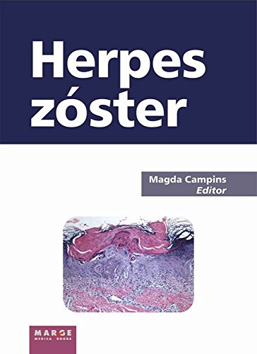 Herpes Zóster