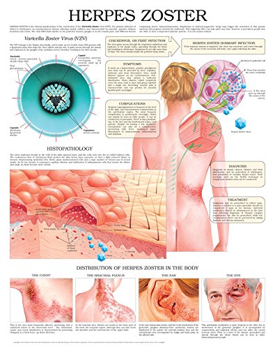 Herpes Zoster e chart: Full illustrated (English Edition)