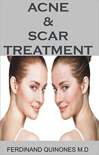 ACNE & SCAR TREATMENT: All You Need To About Curing Acne with Ease, Quickly And Naturally. (English Edition)