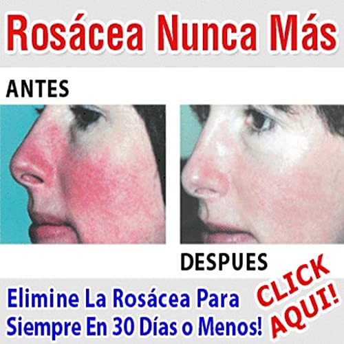 Rosácea.Rosacea Cura