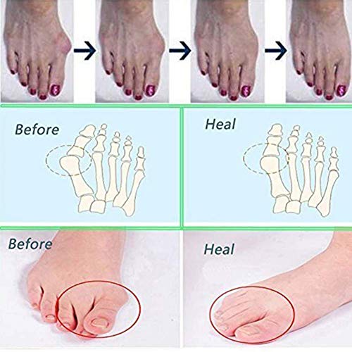 Valgus Bunion Foot Corrector Sandals Pantuflas ortopédicas de Hueso del Dedo Gordo para Hombre Hallux Antideslizante Dolor de Calzado Alivio de síntomas de juanete enrojecimiento e hinchazón del pie