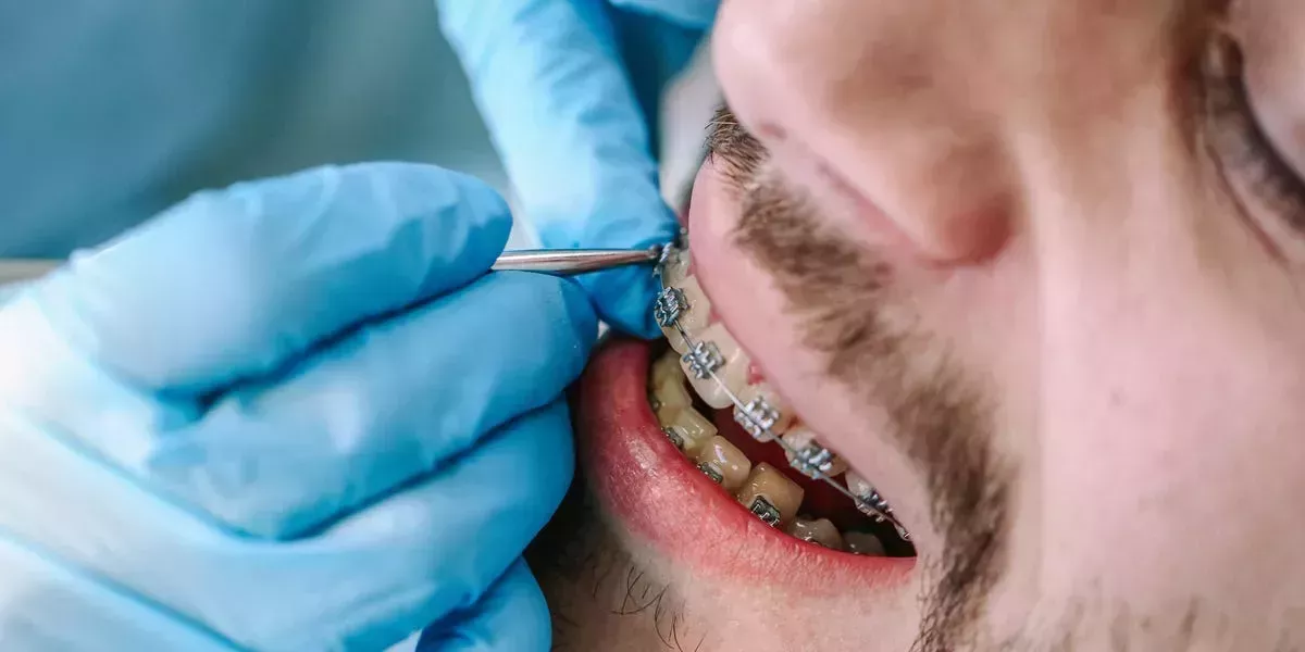 Por qué tienes esas manchas blancas persistentes en los dientes que no desaparecen