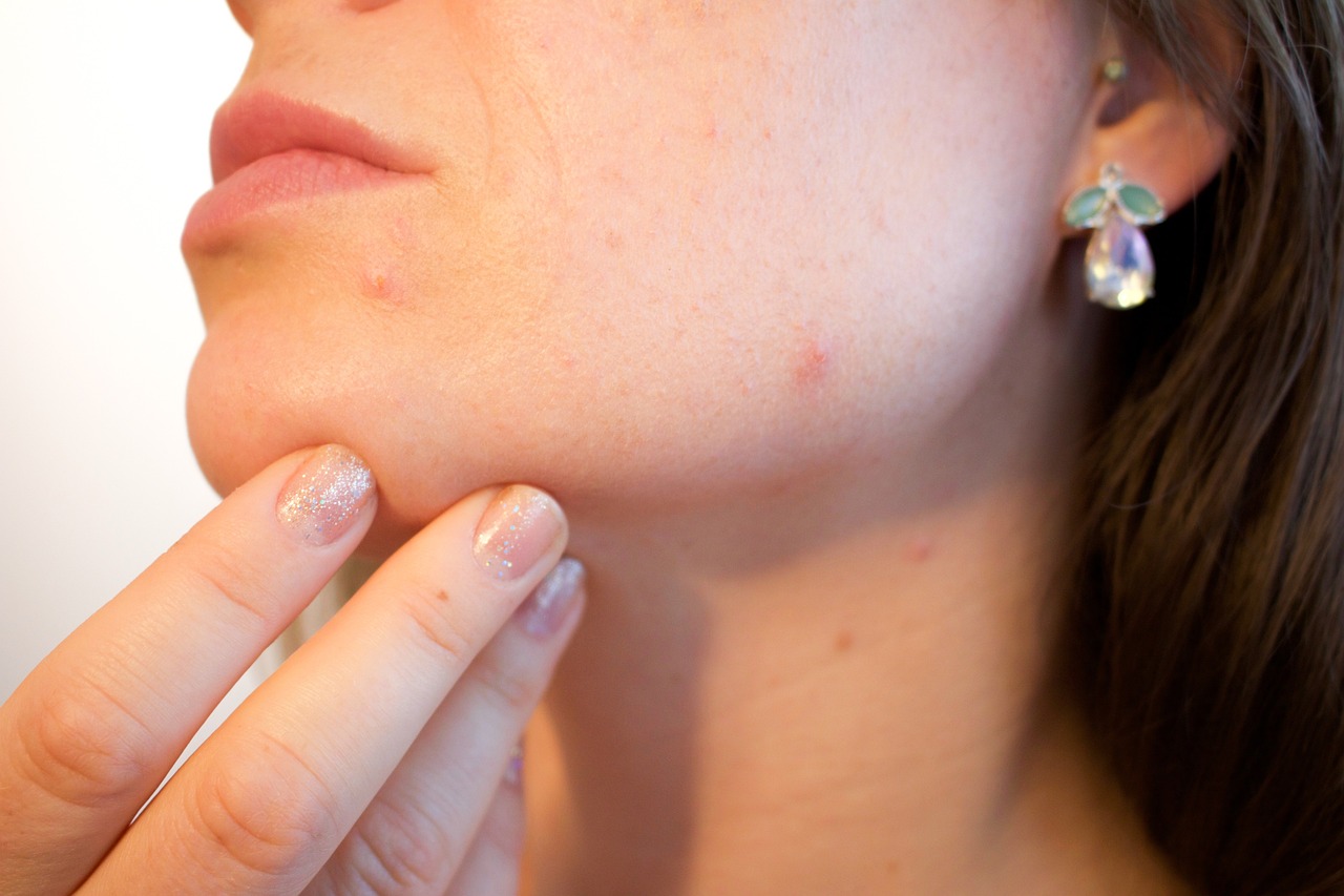 ¿Qué limpiador es bueno para el acné?