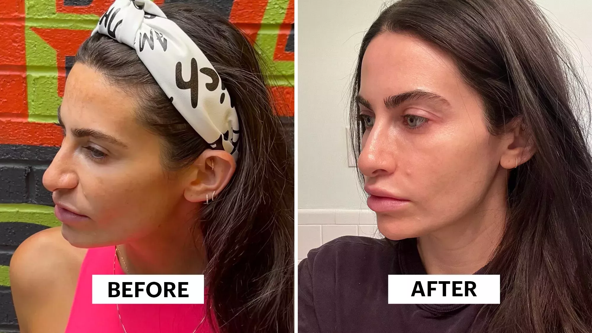 ¿Puede esta píldora eliminar el melasma persistente? Lo he probado