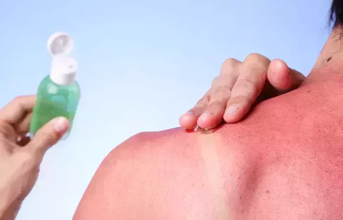 Peeling Por Quemaduras Solares: Remedios caseros y consejos de prevención