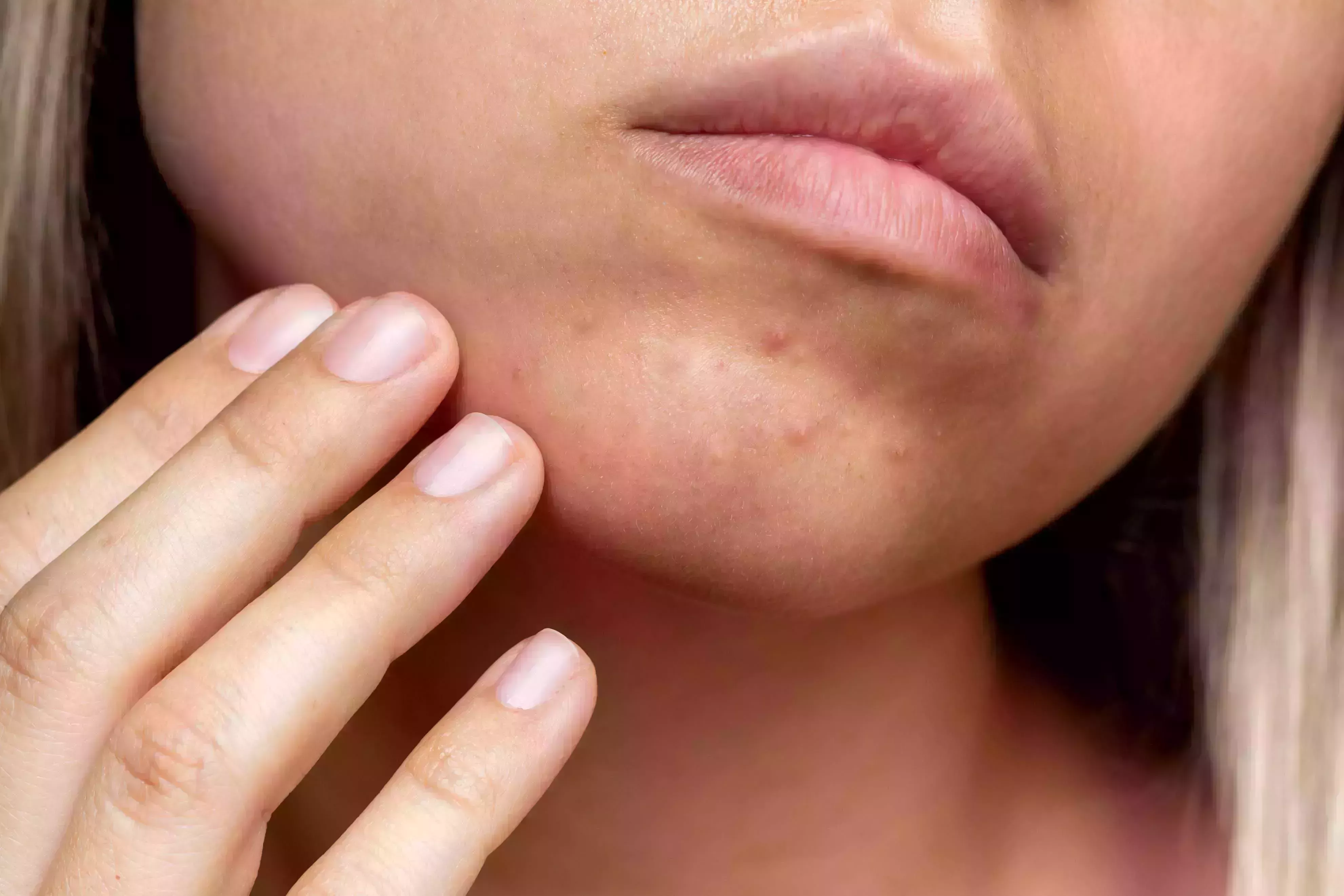 cropped shot of a young woman's face with the problem of acne pimples on the chin allergies, dermatitis, rash problem skin, care and beauty concept dermatology, cosmetology