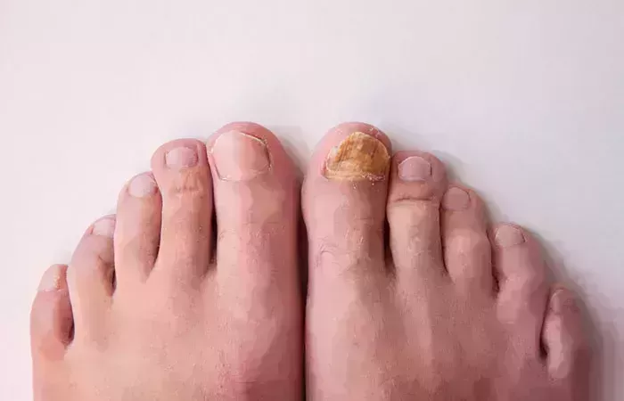 ¿Cómo utilizar el peróxido de hidrógeno para los hongos en las uñas de los pies?