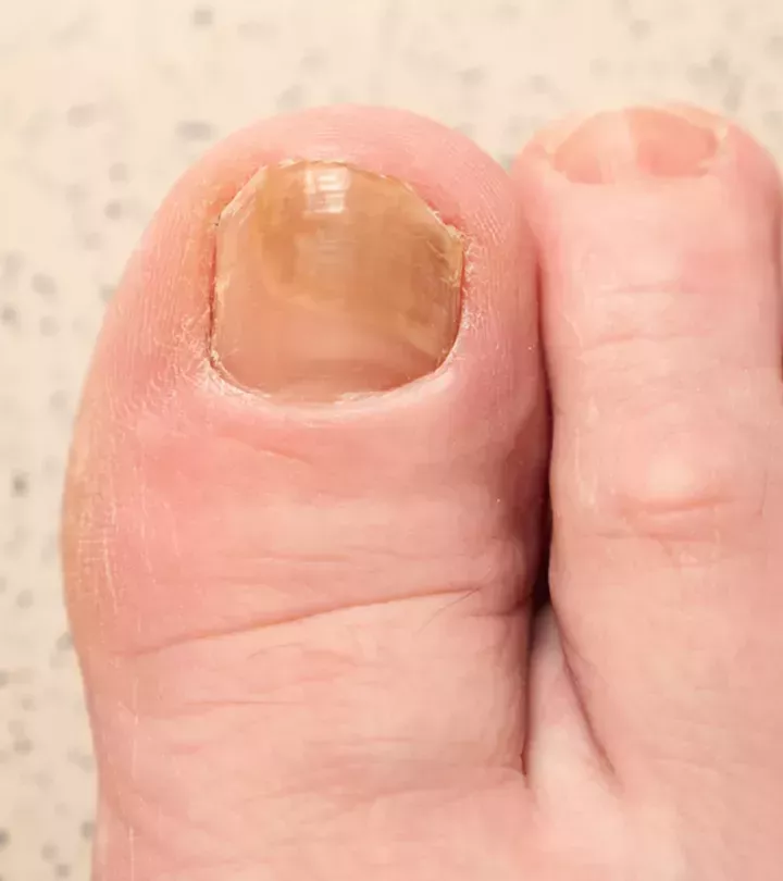 ¿Cómo utilizar el peróxido de hidrógeno para los hongos en las uñas de los pies?