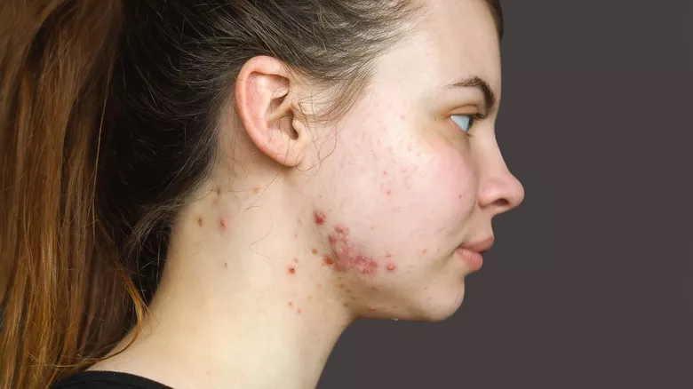 woman with raised acne scars