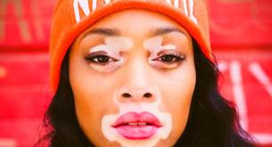 Winnie Harlow: la primera modelo con vitíligo